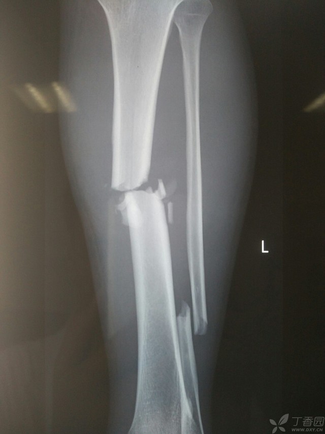 科技重塑胫腓骨骨折康复之旅，引领未来体验新篇章