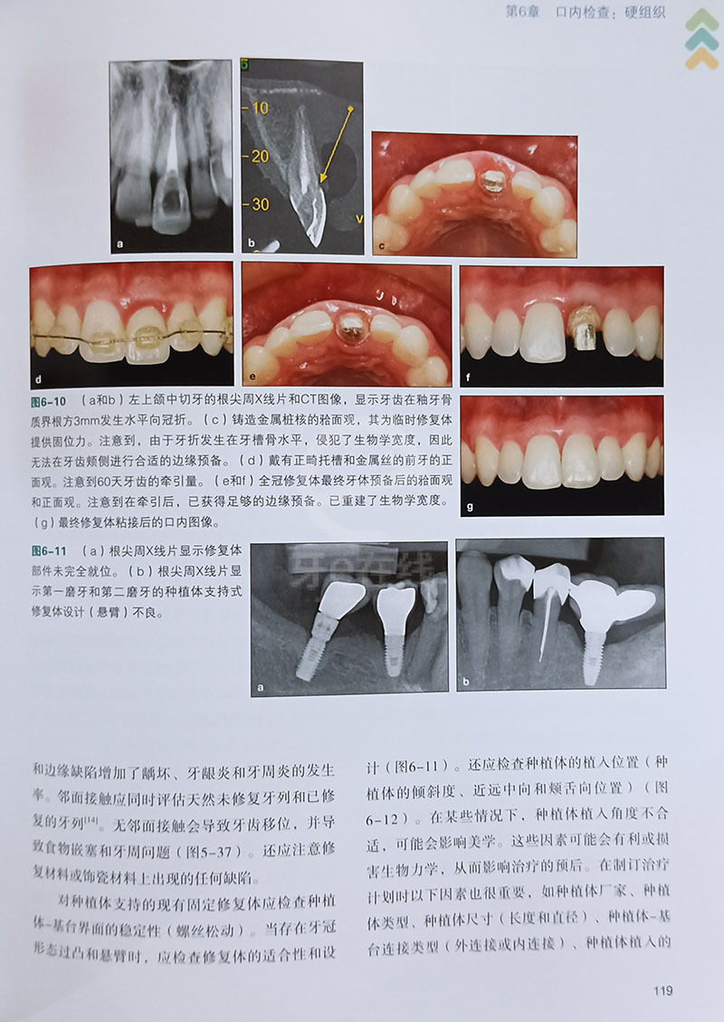 牙齿修复前沿技术观点论述