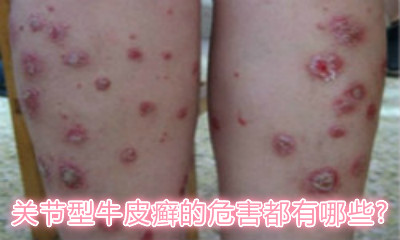 最新牛皮癣治疗方法概览